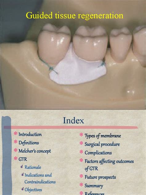 guided tissue regeneration pdf.